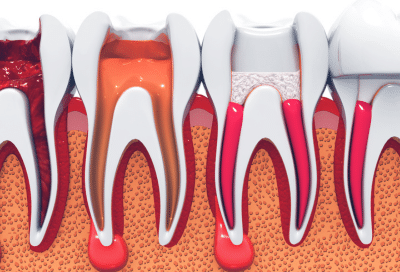 Illustration of canals in teeth, representing root canal treatment