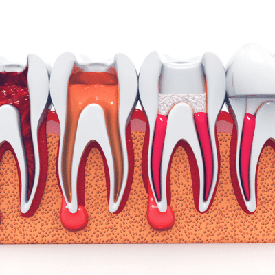 Illustration of canals in teeth, representing root canal treatment